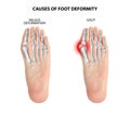 Causes of foot deformity.